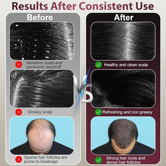 Laser Therapy Hair Growth Comb